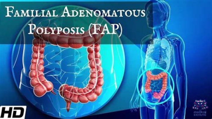 FAP Awareness: How an Idol's Voice Can Light Up the Path for Familial Adenomatous Polyposis Understanding