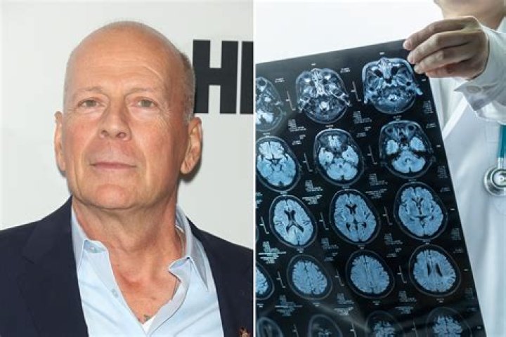 The Ultimate Guide to Bruce Willis Health Condition and Career Impact